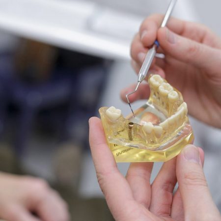 Implantate in Ihrer Zahnarztpraxis Stuttgart